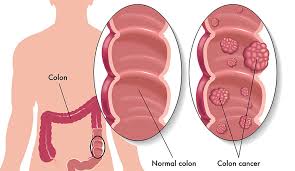 As part of the digestive system, the colon works alongside organs such as the stomach and small intestine to remove stool and maintain your fluid and electrolyte balance. Colon Cancer Awareness Texas Digestive Disease Consultants