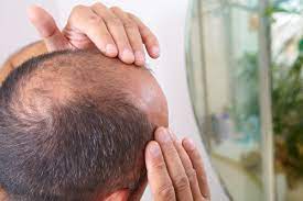 The following adverse reactions are discussed in greater detail in other sections of the labeling a weight loss of greater than 5 lbs. Wellbutrin Hair Loss Can It Cause Problems With Hair