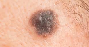 They may also use a special camera or a microscope to take a. What Does Nodular Melanoma Look Like Findatopdoc