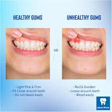 Read to find out more about caring for your teeth and gums. Samaj Dental Having Trouble With Your Gums Lately Here Are The Differences Between A Healthy And An Unhealthy Gums For Any Gums Related Problem Contact Us At 01 4464444 Baneshwor 01 5524799 Jawalakhel Or