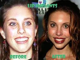 Mum supported my surgery decisions because she knew how unhappy i was before. but she denies reports that she has had any of her ribs removed to. Chloe Lattanzi Plastic Surgery Before And After Photos