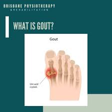 Image result for gout symptoms toe