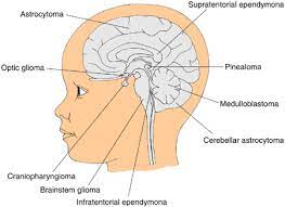 Comfort your baby by holding and gently touching her. Oncology Brain Tumors Children S Wisconsin