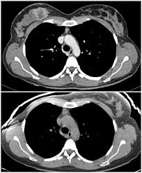 For some patients, getting an a ct scan can detect potential cancer in a lung. Epos Trade