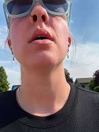 EDIT: I ended up taking the antibiotics. They make me hyper which is so  bizarre to me. Like I actually feel good and that is the only “side  effect”. And I just