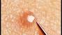 Infected Ingrown Hair On Leg