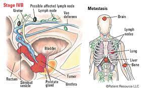 Hello and welcome my prostate cancer also spread to bone mets and lymph nodes. Patient Resource Publishing Advanced Prostate Staging