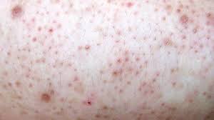 Use a sterile needle, inserting it under hair loops, to gently lift embedded hair tips. Buttocks Breakouts How To Get Rid Of The Bumps On Your Behind Everyday Health