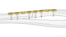 Open reduction; plate fixation for Radius, complete ...