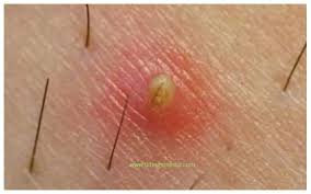 The common symptoms associated with ingrown hair are discussed here.as the infections kick the ingrown hair on the vagina takes a form of vaginal boil or cyst or sore. Ingrown Hair On Vagina Vulva Or Labia Pictures Causes Treatment Home Remedies