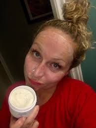 Has anyone experienced acne breakouts after using the Detox Mask?