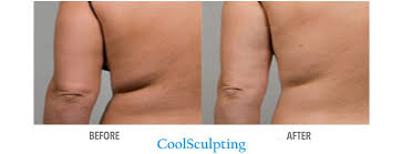 How do you lose fat under your arms? Bye Bye Bra Bulge How To Get Rid Of Armpit Fat With 6 Proven Methods Skinney Medspa