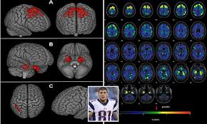 There is no objective test to diagnose adhd. Brain Scans May Reveal Signs Of Cte In Living Nfl Players Daily Mail Online