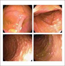 Difficile è la causa più comune di colite associata ad antibiotici e tipicamente ha origine nosocomiale, ma i casi non nosocomiali sono in aumento. Infeccion Por Clostridium Difficile Epidemiologia Diagnostico Y Estrategias Terapeuticas Sciencedirect