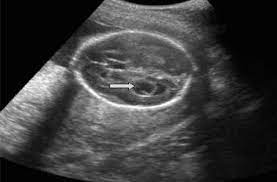 Sagittal Plane Of The Fetal Head Shows A Choroid Plexus Cyst Download Scientific Diagram