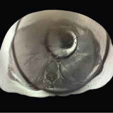 PDF) A Case of Painful Growing Abdominal Wall Mass during Pregnancy  Requiring Resection in the Second Trimester