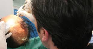 Donato zizi impegnato nella chirurgia della calvizie dal 1999, è stato uno dei primi medici in . Impianto Di Capelli Biocompatibili Centro Tricologico Tricomedit