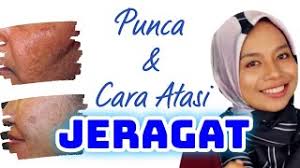 7 rekomendasi bahan produk skincare untuk jerawat. Jeragat Sentiasa Ada Jom Tengok Punca Cara Hilangkan Jeragat Youtube