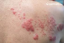 Jenis format gambar yang umum dipakai saat ini. Sukar Sembuh Inilah Jenis Tahapan Dan Gejala Herpes Yang Perlu Diketahui Cermati Com