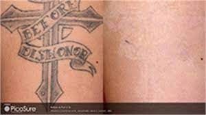 Learn more about how it works. Tattoo Removal With Picosure Laser Pinehurst Nc
