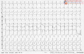 Plicní embolie (ekg) plicní embolii nelze diagnostikovat ani vyloučit pouze na základě ekg, protože se jedná pouze o nespecifické změny. Kazuistika Warfarinizovany Dusny Pacient Kardioblog