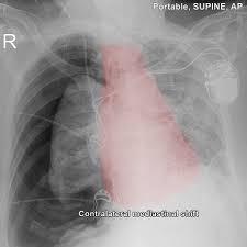 Image result for Open Pneumothorax