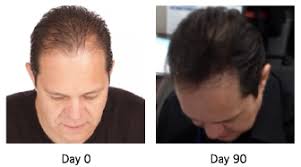 Viviscal is a hair loss supplement in the latter category. Why Viviscal Man Experts And Customers Will Tell You
