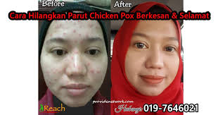 Cara Hilangkan Parut Chicken Pox Dewasa Yang Berkesan Selamat