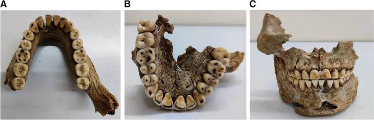Identification of fragmented cranial remains excavated from a site adjoining Ajnala well: a forensic anthropological case report | Egyptian Journal of Forensic Sciences | Springer Nature Link