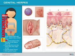 There are two types of herpes simplex virus. Hsv 2