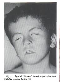 Mobius Syndrome and Poland Anomaly: Case Report and Review of the  Literature