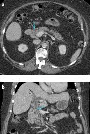 What does a ct scan show? Mistakes In Acute Abdominal Ct And How To Avoid Them Ueg United European Gastroenterology