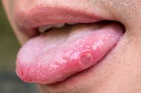 It can be caused by a serious infection, but also could be one of the early signs of throat cancer. 7 Signs Your Painful Mouth Sore Could Be Something More Serious Health Essentials From Cleveland Clinic