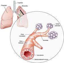 La bronchiolite aiguë est une maladie respiratoire d'origine virale qui touche principalement les enfants de moins de 2 ans lors d'épidémies saisonnières hivernales. Les Causes Et La Prevention De La Bronchiolite Vidal