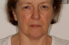 All On Six Dental Implants