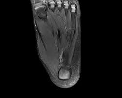 Indications for foot mri scan. Hypertrophic Abductor Hallucis Muscle Radiology Case Radiopaedia Org
