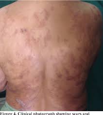 Nagy örömünkre szolgál fellépőként bejelenteni az iac jeles képviselőjét, a szegedi lepra zenekart, akiknek előreláthatóan ez lesz az egyetlen idei budapesti fe.llépése! Figure 3 From Type 2 Lepra Reaction Enl Presenting With Extensive Cutaneous Ulcerations Reakcja Leprotyczna Typu 2 Go Enl Z Rozlegeymi Owrzodzeniami Skornymi Semantic Scholar