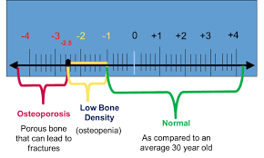 Understanding Bone Density Results American Bone Health