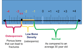 understanding bone density results american bone health