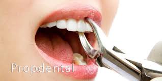 Extraccion Dental Que Hacer Tras Una Extraccion Dental