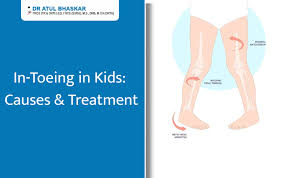 Image result for In-Toeing