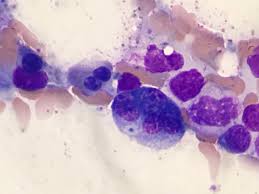 Maybe you would like to learn more about one of these? Fernando Martin Moro On Twitter Bi And Multinucleated Erythroblasts Seen In A Bone Marrow Sample Of A Patient Diagnosed By Mds With Multilineage Dysplasia Cytopath Hemepath Dysplastic Https T Co 731haqnlxf