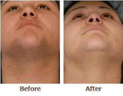 The pigment in the hair follicle absorbs two challenges are red and gray hair; Laser Hair Removal Heather Rocheford Md