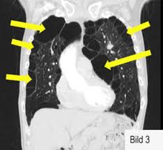 Pneumothorax Universitatsklinikum Freiburg