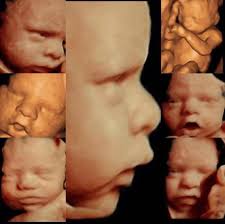 HDLive is the most advanced scanning technology with its lifelike clarity  it will take your breath away. We are one of the only scanning clinics in  The North East bringing this amazing