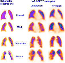 Image result for Ventilation Perfusion Scan