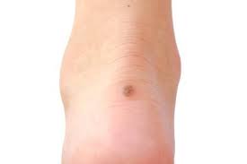 Unfortunately foot cancer is a reality for thousands of americans each and every year. Skin Cancer Can Happen On Your Feet Stavros Alexopoulos D P M Podiatry