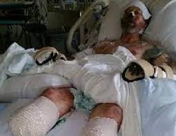 The Shocking Reason Why Man S Legs And Hands Were Amputated A Dog S Saliva