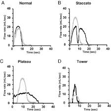 Objective Patterning Of Uroflowmetry Curves In Children With