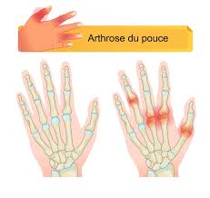 Des gonflements douloureux des articulations, le plus souvent des doigts, accompagnés de raideur matinale sont liés à l'inflammation (arthrites). Qu Est Ce Que L Arthrose Du Pouce Ou Rhizarthrose